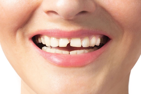 How An Emergency Dentist Fixes A Broken Tooth