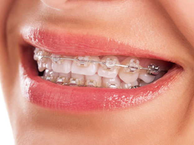 The Form Of Braces People May Not Know About: Ceramic Braces