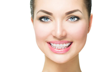 The Benefits Of Clear Braces In Sterling And Invisalign