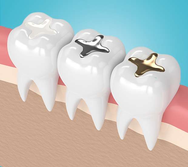 Sterling Composite Fillings