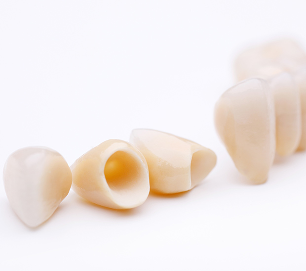 Sterling Dental Crowns and Dental Bridges