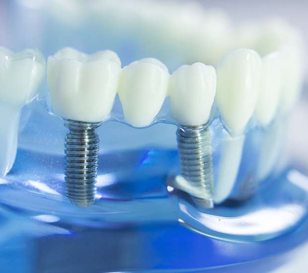 Sterling Dental Implants