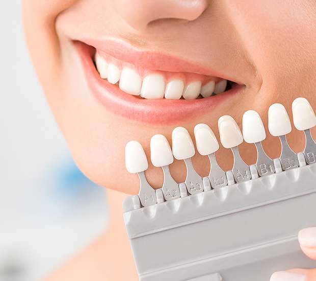 Sterling Dental Veneers and Dental Laminates