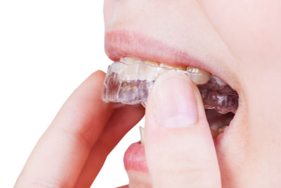 Invisalign Dentist