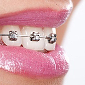 Orthodontics for Adults