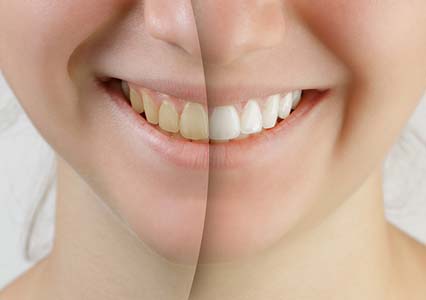 Teeth Whitening Service