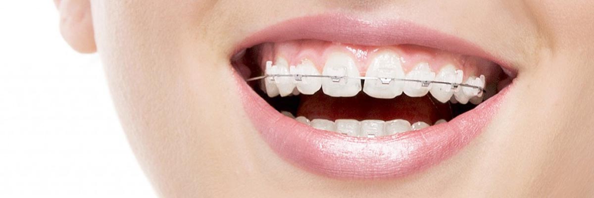 Sterling Types of Braces