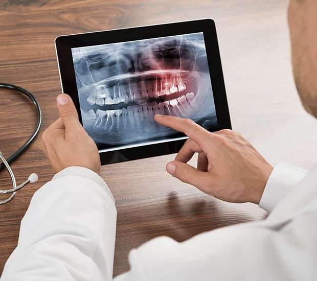 Sterling Types of Dental Root Fractures